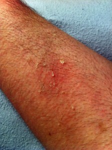 Skin peel after burning itching side effects