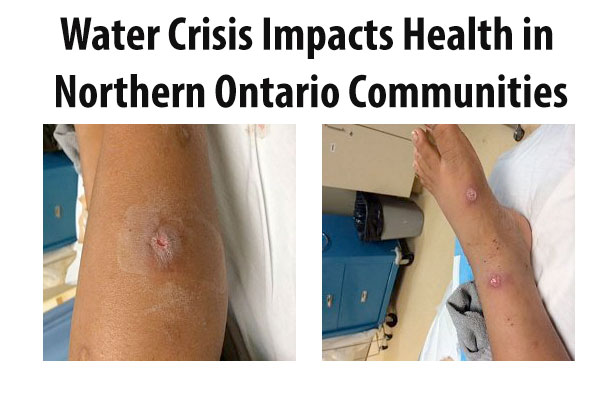 Water crisis is making people sick and creating serious health issues in First Nations communities