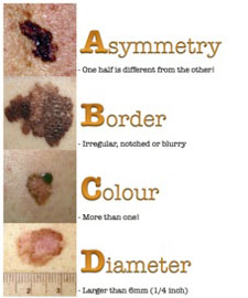Make an appointment with your primary care provider if you have suspicious changes in moles or freckles. Use the acronym ABCD to remember what you are looking for: asymmetry, border irregularity, colour, and diameter greater than ¼ inch or 6mm.