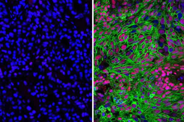 Researchers at the University of Texas at Dallas have found that two types of non-small cell lung cancer metabolize glucose -- a type of sugar -- differently. A glucose transporter called GLUT1, shown in green, is much more prevalent in lung squamous cell carcinoma cells (right) in comparison to lung adenocarcinoma cells (left). The findings, published in the online journal Nature Communications, may aid the development of new lung cancer therapies targeted at inhibiting GLUT1.