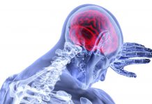 New Study Finds Few Stroke Survivors Are Being Screened for Osteoporosis Nootropics