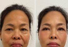 Bid Farewell to Facelifts: Dr. Simon Ourian’s Revolutionary Non-Surgical Solution You Simply Cannot Overlook