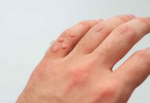 Why Some People Are Wart-Prone? Warts