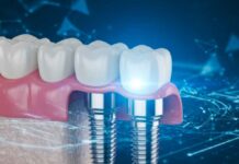 Everything You Need To Know About Getting A Dental Implant Bridge dental bridge success