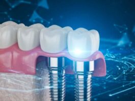Best Invisalign Dentist in Hillsboro, Oregon: Why More Patients Are Choosing Hillsboro Dental Excellence dental bridge success