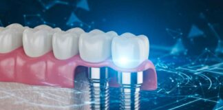 Best Invisalign Dentist in Hillsboro, Oregon: Why More Patients Are Choosing Hillsboro Dental Excellence dental bridge success