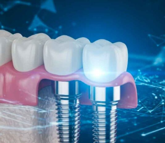 Why Dental Implants Are a Long-Term Solution for Tooth Loss dental bridge success