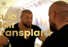 Before You Wire the Deposit: 5 Red Flags to Avoid — and Turkey’s Top 10 Hair Transplant Clinics for 2026 Hair transplant